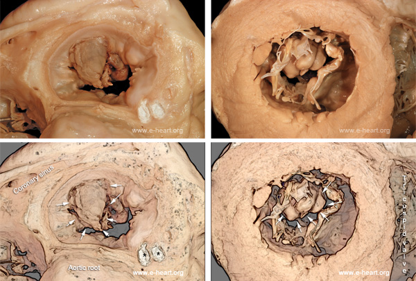 Mitral valve endocarditis